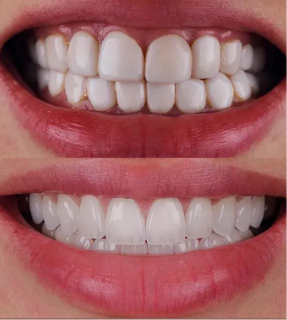 Post estático dental